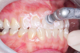 予防・クリーニング